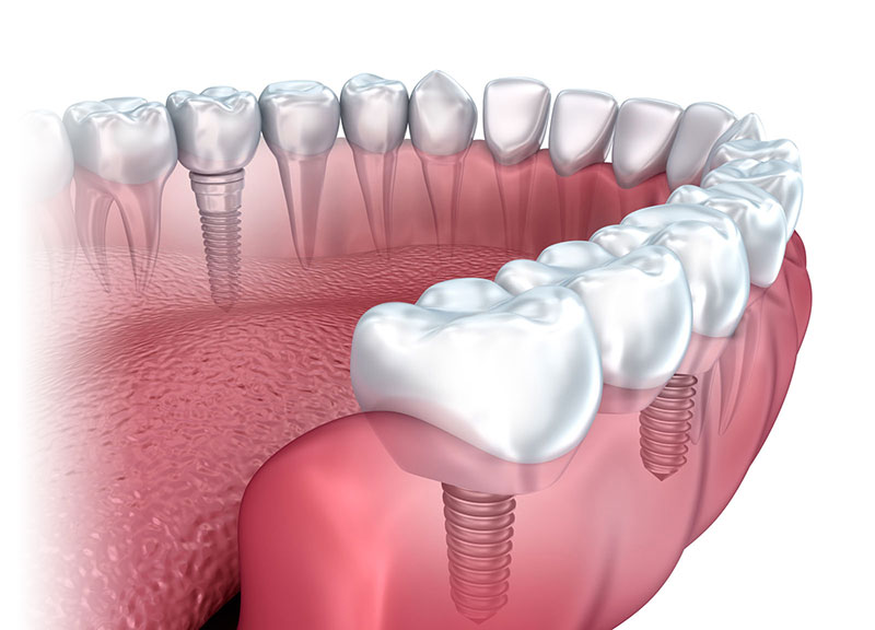 Dental Implants